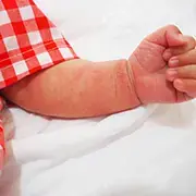Uso de Fórmula Infantil parcialmente hidrolisada em lactentes com e sem risco de manifestações alérgicas (publications) Uso de Fórmula Infantil parcialmente hidrolisada em lactentes com e sem risco de manifestações alérgicas (publications)